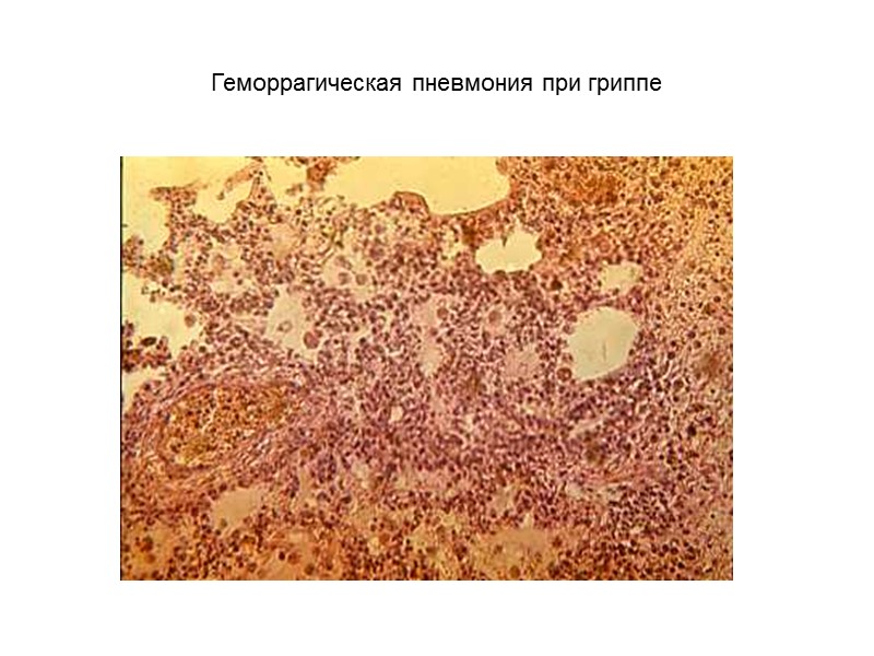 Геморрагическая пневмония при гриппе
